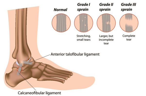 Sprained Ankle Anatomy
